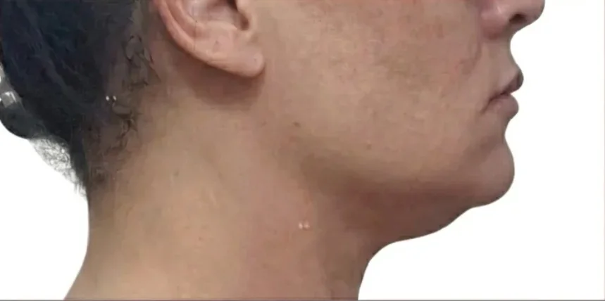 Antes: perfil com flacidez e gordura na papada