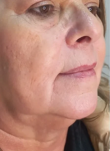 Antes: lábios com pouco volume e contorno apagado