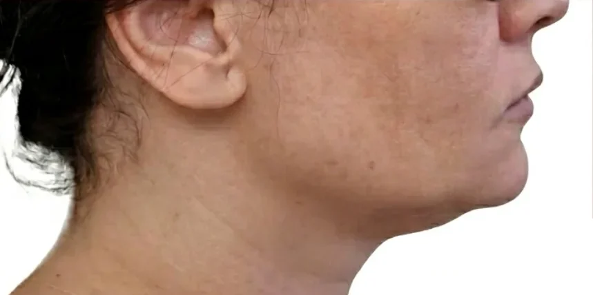 Depois: perfil com contorno da mandíbula mais definido
